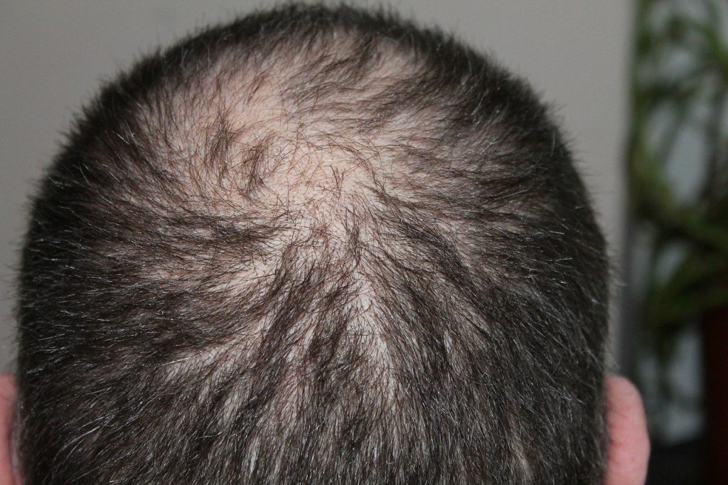 hair loss - wapomu.com