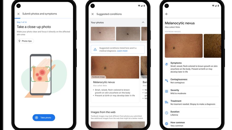 google AI tool for skin diseases