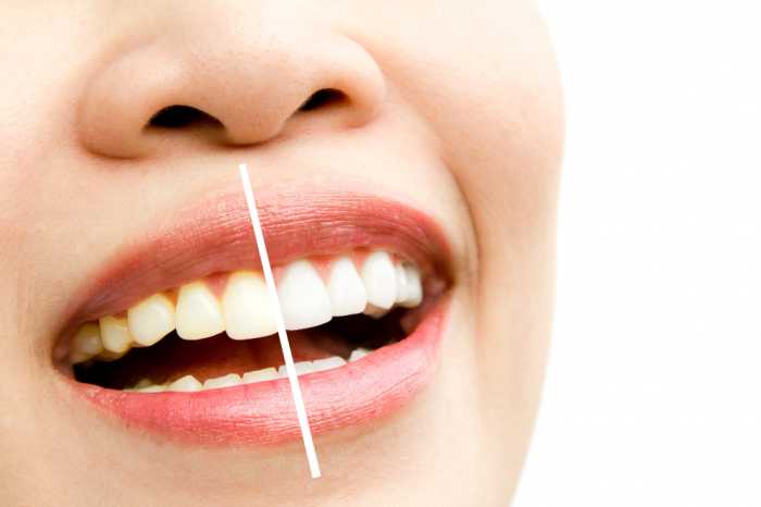 Whitening of your teeth