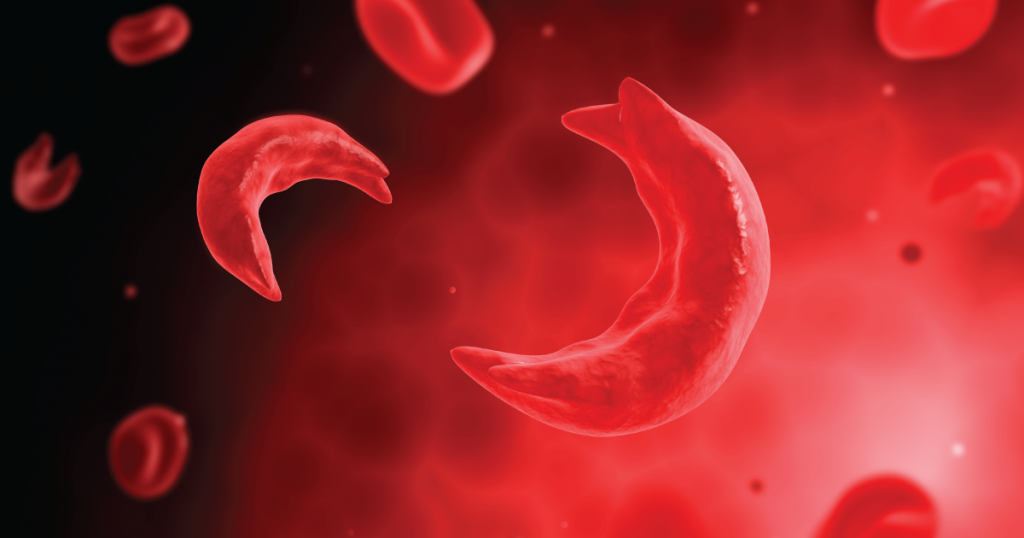 sickle cell disease