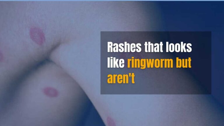 rashes that looks like ringworm but aren't